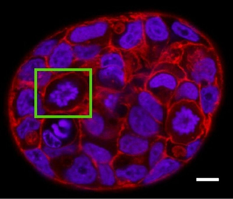 A mini-tumor of human breast epithelial cells (MCF-7). A dividing cell indicated in green.